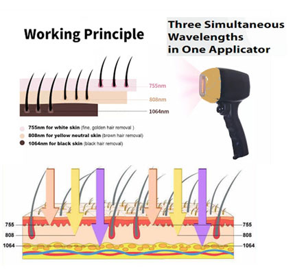 Laser Hair Removal working principle